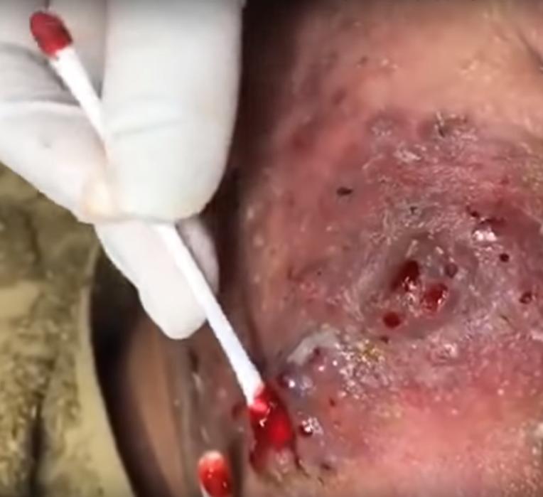 How to remove blackheads safely without damaging skin
